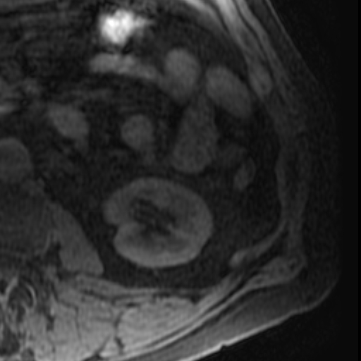 File:Atypical renal cyst on MRI (Radiopaedia 17349-17046 Axial T1 fat sat 22).jpg