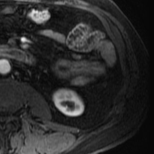 File:Atypical renal cyst on MRI (Radiopaedia 17349-17046 C 27).jpg