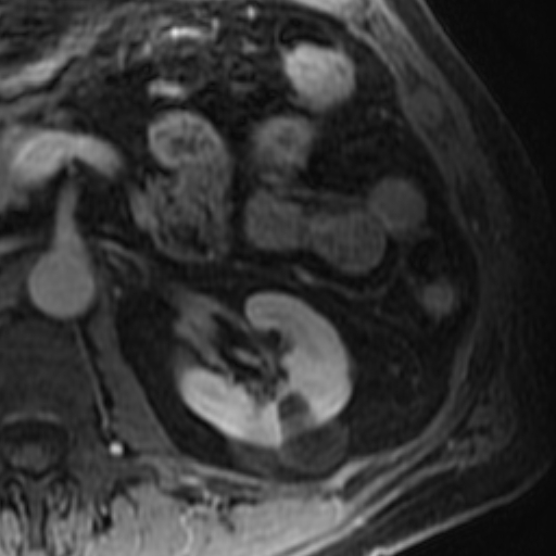 File:Atypical renal cyst on MRI (Radiopaedia 17349-17046 D 14).jpg