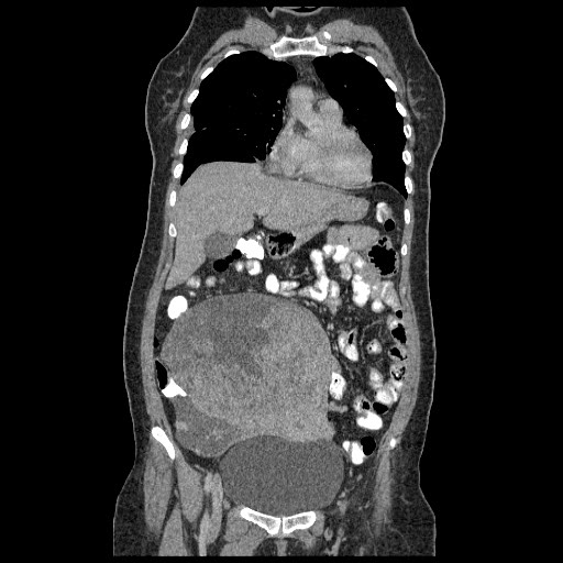 File:Atypical retroperitoneal lymphocoeles with large leiomyoma of uterus (Radiopaedia 32084-33024 B 7).jpg