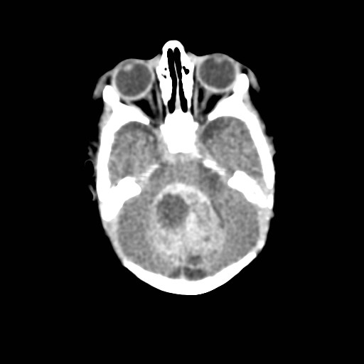 File:Atypical teratoid rhabdoid tumor (prenatal US and neonatal MRI) (Radiopaedia 59091-66387 Axial non-contrast 13).jpg