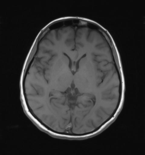 File:Autoimmune limbic encephalitis (Radiopaedia 30363-31005 Axial T1 17).jpg