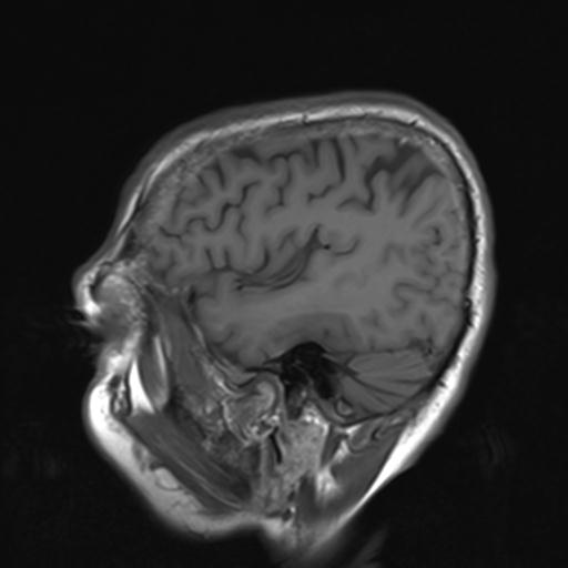 File:Autoimmune limbic encephalitis (Radiopaedia 30363-31005 Sagittal T1 21).jpg