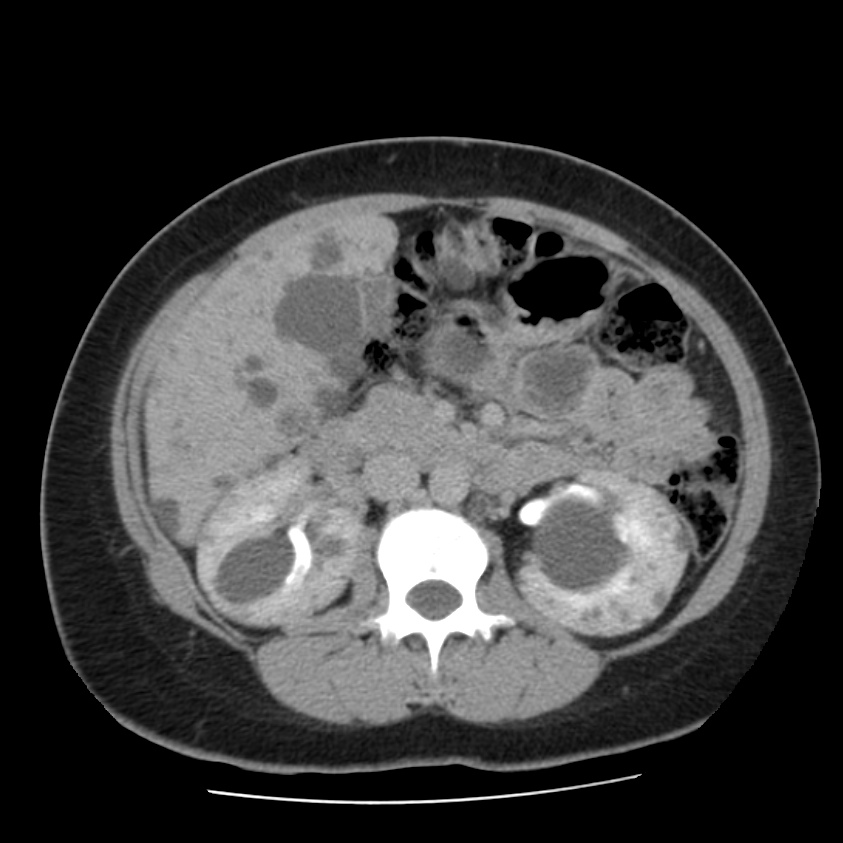 Autosomal dominant polycystic kidney disease (Radiopaedia 23061-23093 C+ delayed 29).jpg