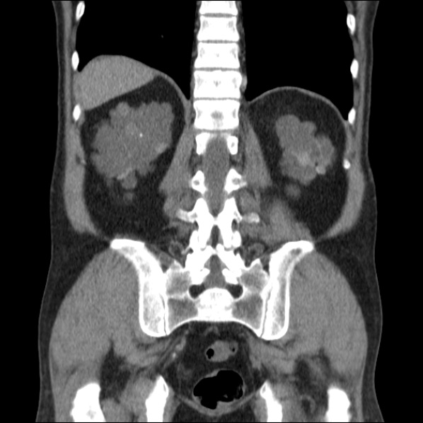 File:Autosomal dominant polycystic kidney disease (Radiopaedia 36539-38101 C 52).jpg