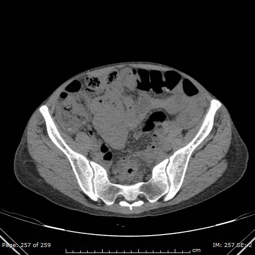 File:Autosomal dominant polycystic kidney disease (Radiopaedia 44122-47684 Axial 90).jpg