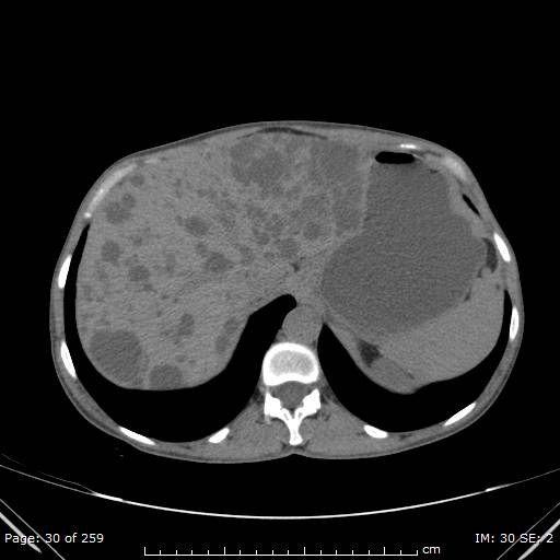 Autosomal dominant polycystic kidney disease (Radiopaedia 44122-47684 Axial non-contrast 11).jpg