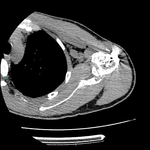 Avascular necrosis after fracture dislocations of the proximal humerus (Radiopaedia 88078-104655 D 58).jpg