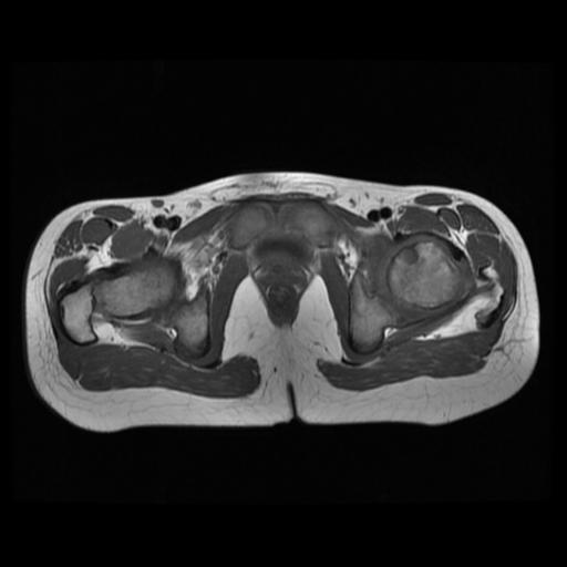 File:Avascular necrosis of the hip (Radiopaedia 29563-30067 Axial T1 11).jpg