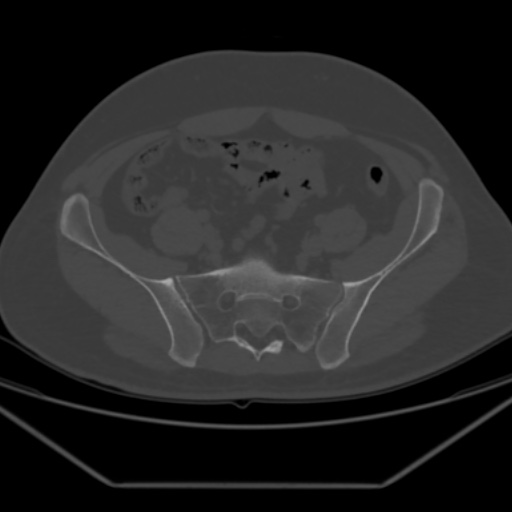 File:Avascular necrosis of the hip (Radiopaedia 61503-69467 Axial bone window 12).jpg