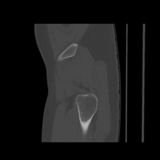 File:Avascular necrosis of the hip (Radiopaedia 61503-69467 B 5).jpg