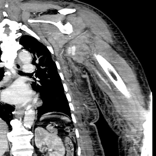 File:Axillary arterial pseudoaneurysm (Radiopaedia 24925-25195 B 13).jpg