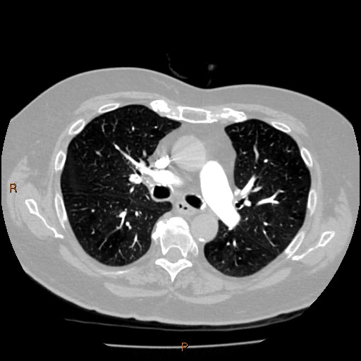 Azygos lobe (Radiopaedia 40161-42821 Axial lung window 28).jpg