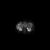 B-cell lymphoma of the mesentery (Radiopaedia 65743-74868 18F-FDG PET-CT 149).jpg