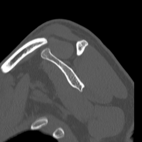 Bankart lesion (Radiopaedia 57256-64185 Sagittal bone window 36).jpg