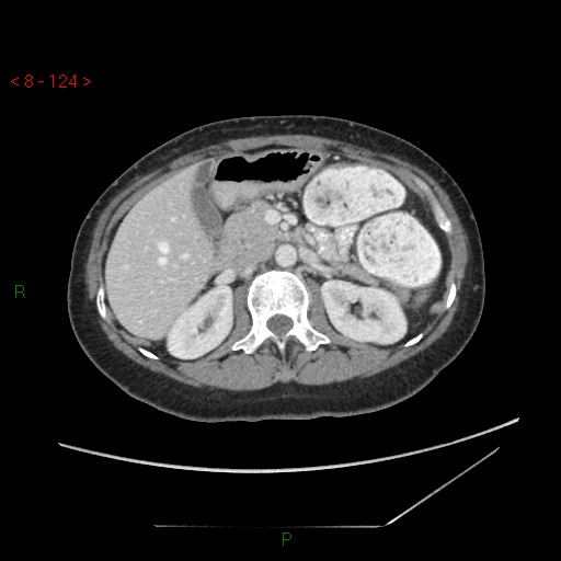 Bartholin gland cyst (Radiopaedia 54904-61181 A 31).jpg