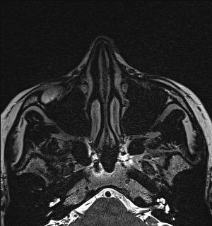 Basal cell carcinoma - nasal region (Radiopaedia 70292-80365 Axial Gradient Echo 32).jpg
