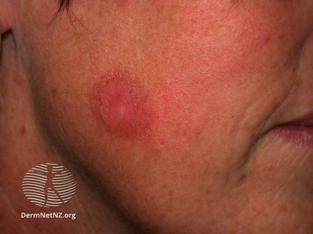 File:Basal cell carcinoma affecting the face (DermNet NZ lesions-bcc-face-0871).jpg