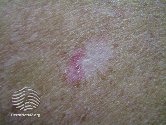 File:Basal cell carcinoma affecting the trunk (DermNet NZ lesions-bcc-trunk-0695).jpg