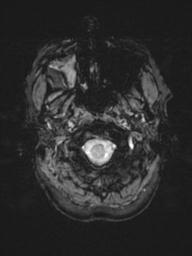 Base of skull chondrosarcoma (Radiopaedia 30410-31070 Axial SWI 4).jpg