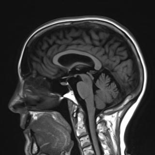 File:Base of skull chondrosarcoma (Radiopaedia 30410-31070 Sagittal T1 10).jpg