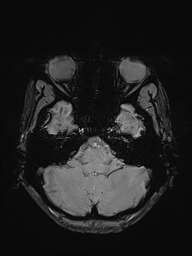 Basilar artery perforator aneurysm (Radiopaedia 82455-97733 Axial SWI 10).jpg
