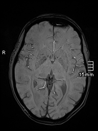 Basilar artery perforator aneurysm (Radiopaedia 82455-99523 Axial SWI 33).jpg