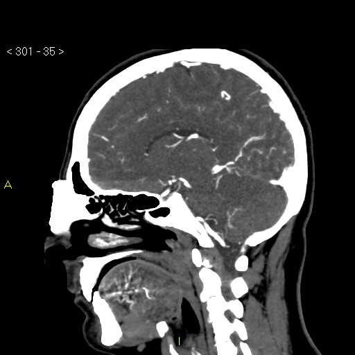 Basilar artery thrombosis (Radiopaedia 16260-15944 C 29).jpg