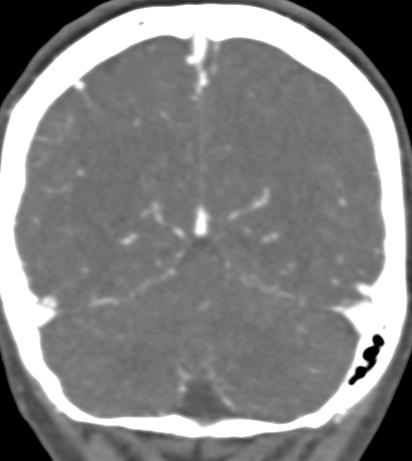 Basilar tip aneurysm with coiling (Radiopaedia 53912-60086 B 122).jpg