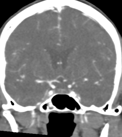 Basilar tip aneurysm with coiling (Radiopaedia 53912-60086 B 63).jpg