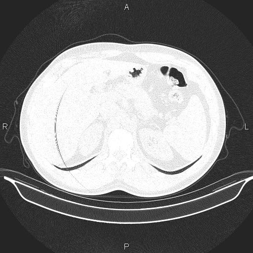 File:Beam hardening and ring artifacts (Radiopaedia 85323-100915 Axial lung window 74).jpg