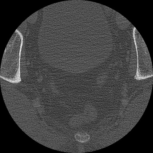 Benign post-traumatic pseudopneumoperitoneum (Radiopaedia 71199-81495 Axial bone window 319).jpg