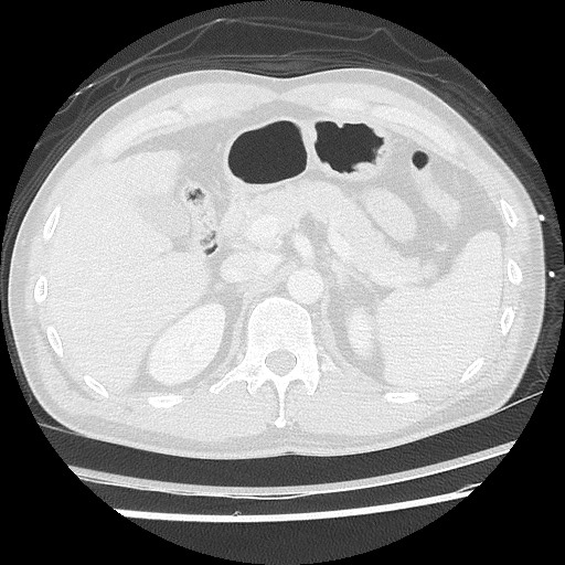 Benign post-traumatic pseudopneumoperitoneum (Radiopaedia 71199-81495 Axial lung window 72).jpg