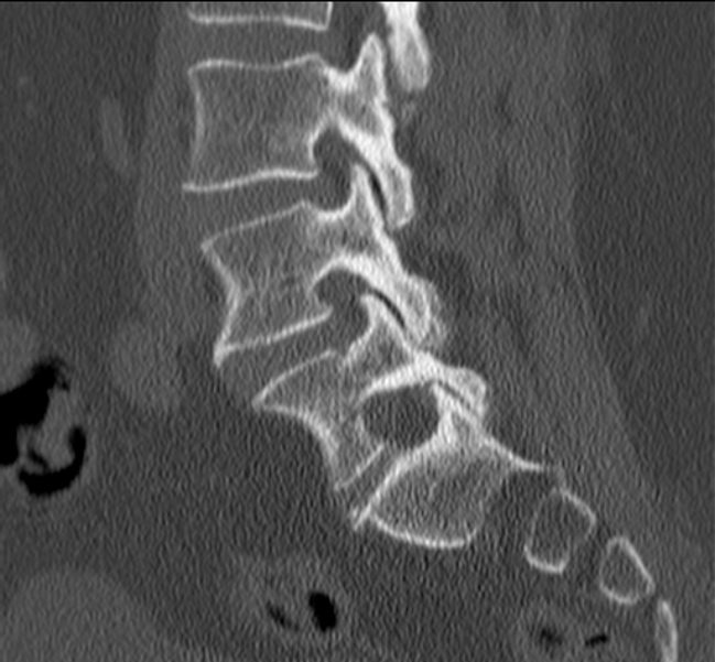 Bertolotti syndrome (Radiopaedia 24864-25128 Sagittal bone window 21).jpg