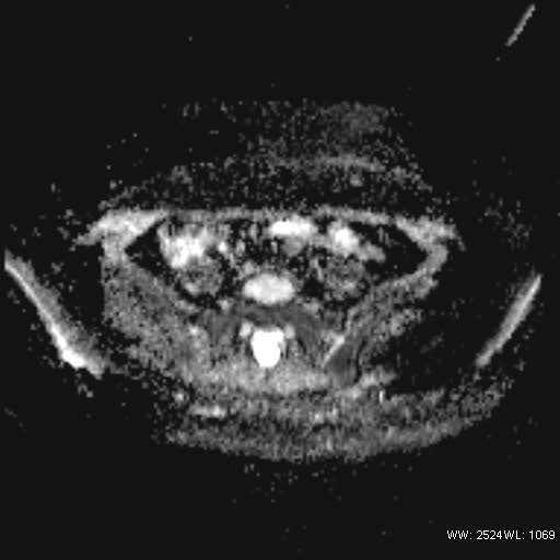File:Bicornuate uterus- on MRI (Radiopaedia 49206-54297 Axial ADC 6).jpg