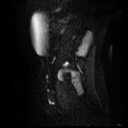 File:Bicornuate uterus (Radiopaedia 51676-57472 Sagittal DWI 29).jpg