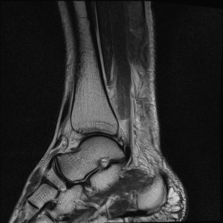 File:Bilateral Achilles tendon complete tear (Radiopaedia 81344-95051 Sagittal T2 11).jpg