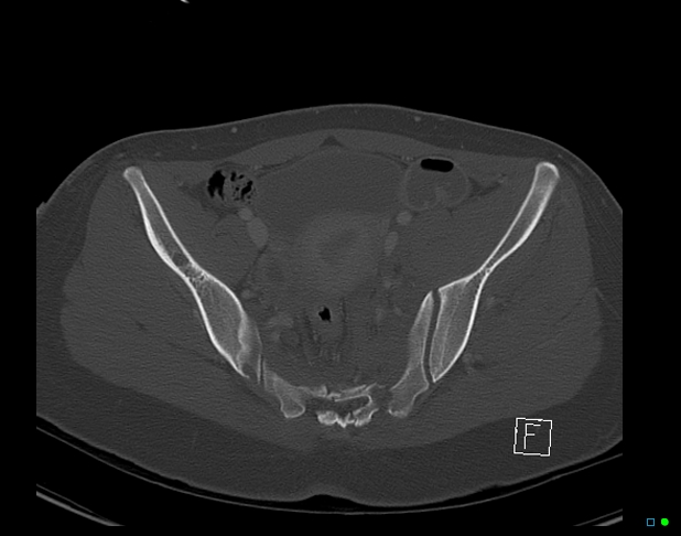 Bilateral acetabular fractures (Radiopaedia 79272-92308 Axial bone window 28).jpg