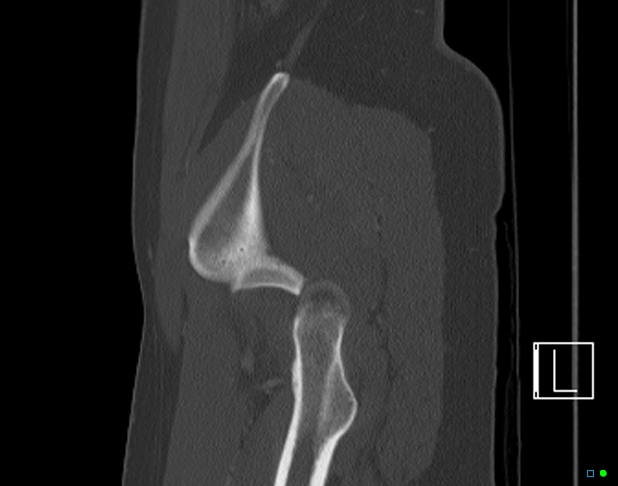 Bilateral acetabular fractures (Radiopaedia 79272-92308 Sagittal bone window 76).jpg