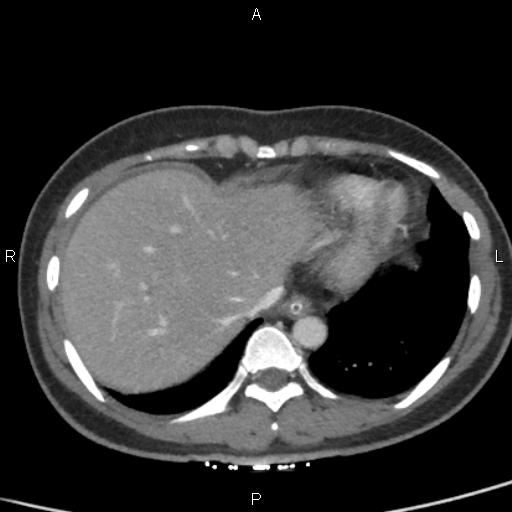 Bilateral adrenal gland hyperenhancement in pancreatitis (Radiopaedia 86642-102753 E 10).jpg