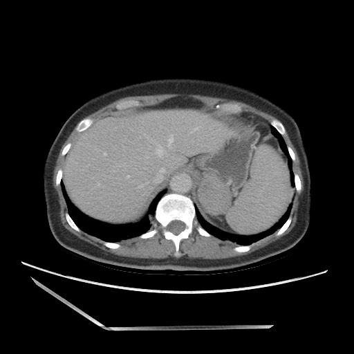 Bilateral adrenal granulocytic sarcomas (chloromas) (Radiopaedia 78375-91007 A 24).jpg
