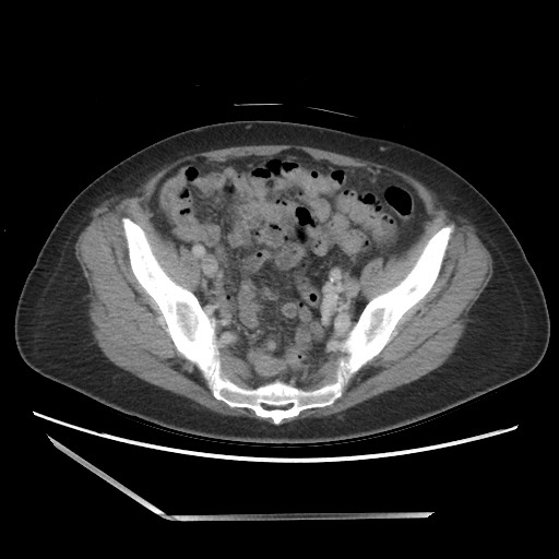File:Bilateral adrenal granulocytic sarcomas (chloromas) (Radiopaedia 78375-91007 A 94).jpg