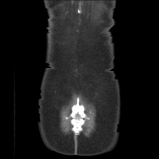 Bilateral adrenal granulocytic sarcomas (chloromas) (Radiopaedia 78375-91007 B 87).jpg