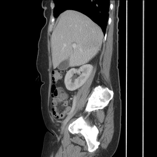 File:Bilateral adrenal granulocytic sarcomas (chloromas) (Radiopaedia 78375-91007 C 51).jpg