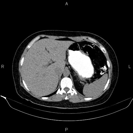 File:Bilateral adrenal myelolipoma (Radiopaedia 63058-71535 Axial non-contrast 36).jpg