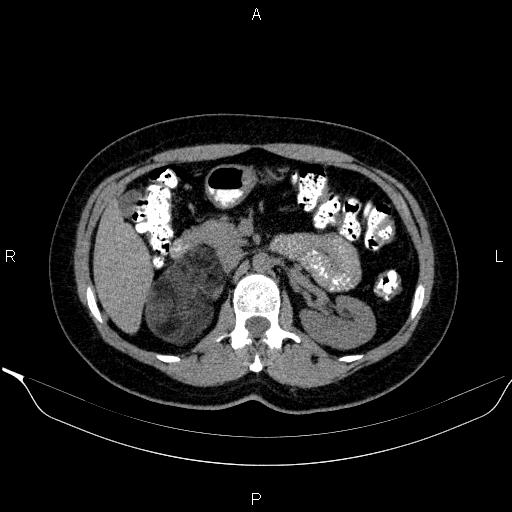 File:Bilateral adrenal myelolipoma (Radiopaedia 63058-71535 Axial non-contrast 63).jpg