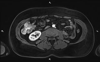 Bilateral adrenal myelolipoma (Radiopaedia 63058-71537 Axial T1 C+ fat sat 62).jpg