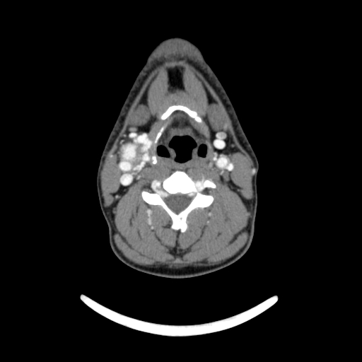 Bilateral carotid body tumors (Radiopaedia 52899-58827 A 2).jpg