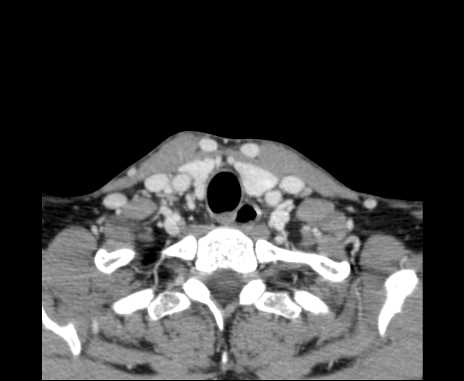 Bilateral carotid body tumors (Radiopaedia 61841-69870 Axial Post contrast 100).jpg