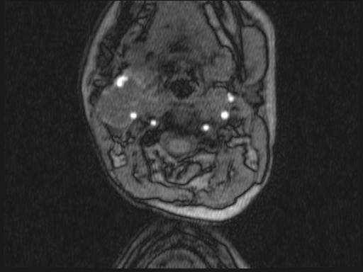 Bilateral carotid body tumors and right glomus jugulare tumor (Radiopaedia 20024-20060 Axial MRA 262).jpg